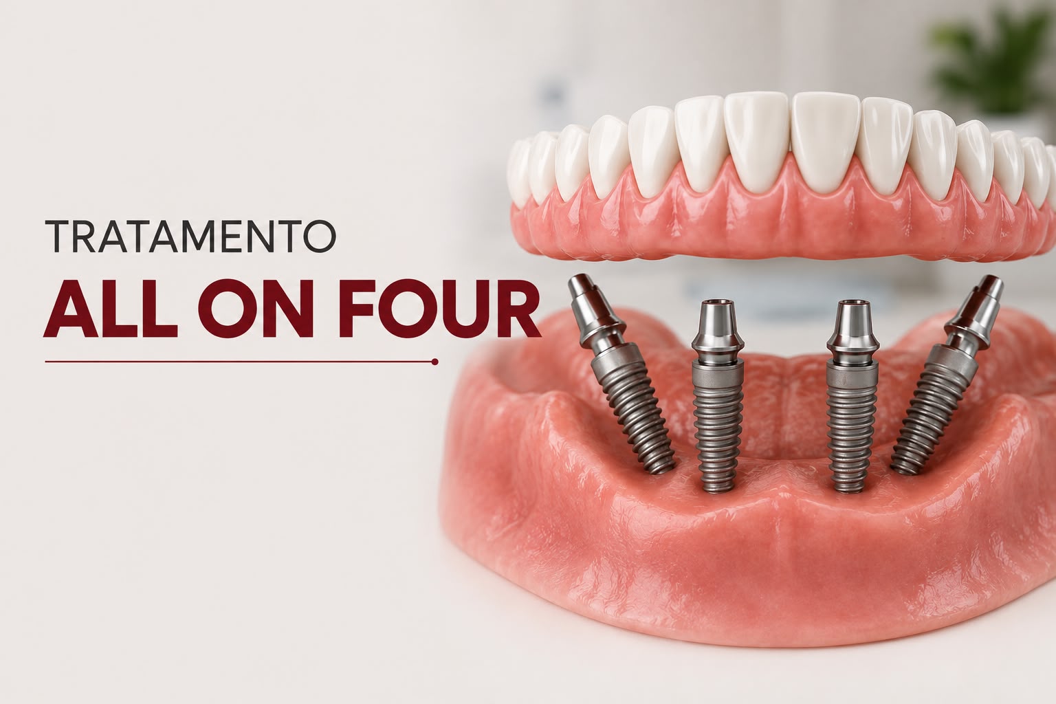 Modelo de prótese fixa All On Four sobre quatro implantes dentários